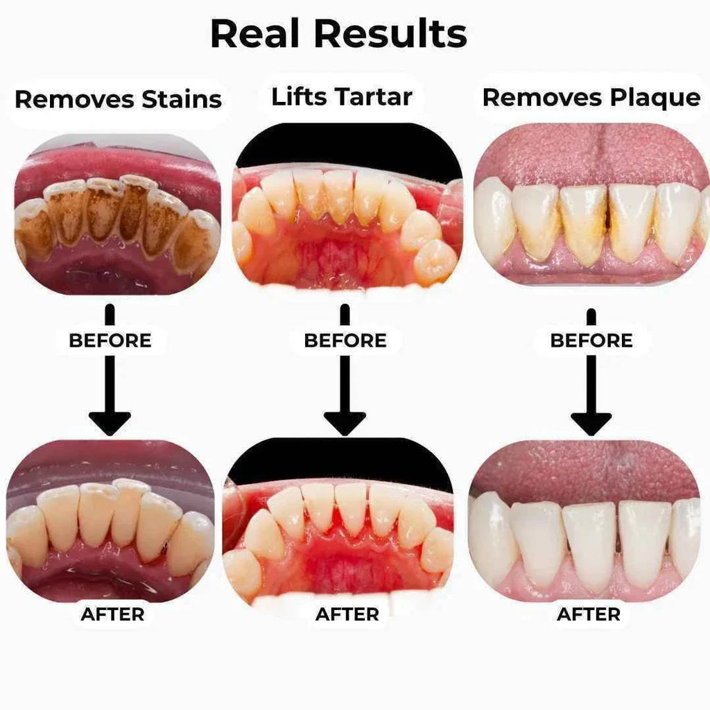 T5 Ultrasonic Tooth Cleaner | Advanced Plaque & Tartar Remover